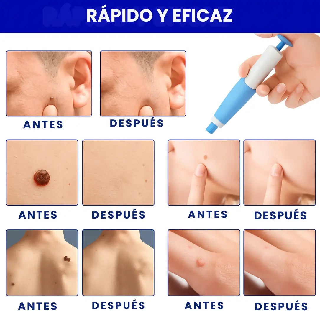 QUITA VERRUGAS CON ACCESORIOS