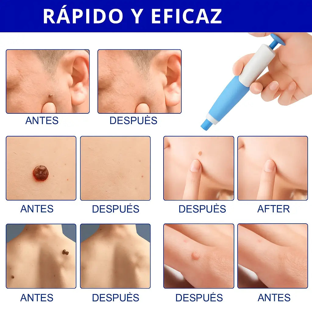 QUITA VERRUGAS CON ACCESORIOS